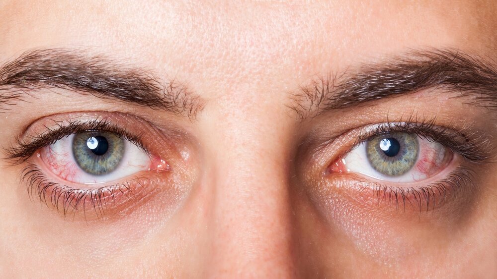 افزایش سرطان‌های سطح چشم / تشدید علائم بیماری‌های چشمی با قرار گرفتن در معرض آلودگی هوا