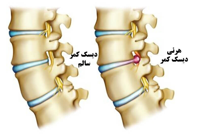 10 حرکت مفید ورزش اصلاحی دیسک کمر در خانه + علائم و روش های درمانی