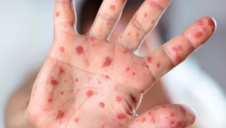 فعالیت گروه‌های ضد واکسن از دلایل شیوع سرخک در کشور است