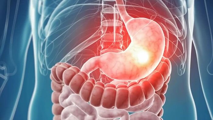 علائم پنهان هشدار سرطان معده
