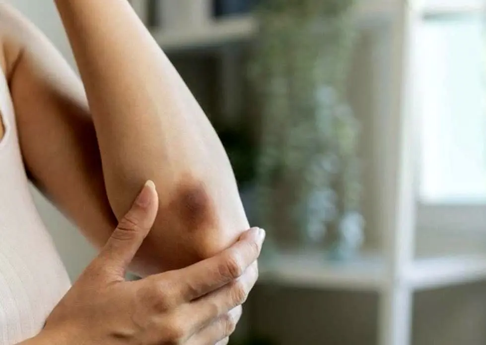 اختلال نادری که پشت کبودی‌های شما پنهان شده