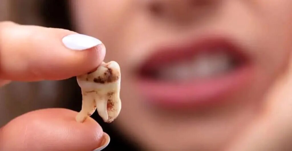 چرا دندان‌ها زود به زود پوسیده می‌شوند؟