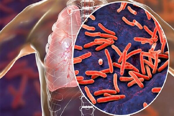 بیماری سل چیست و چرا هنوز هم مهم است؟ | ایران در مسیر از بین بردن آمار و چالش های سل