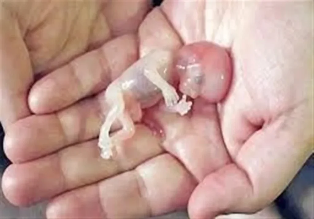 سقط سالانه 5000 جنین در گلستان