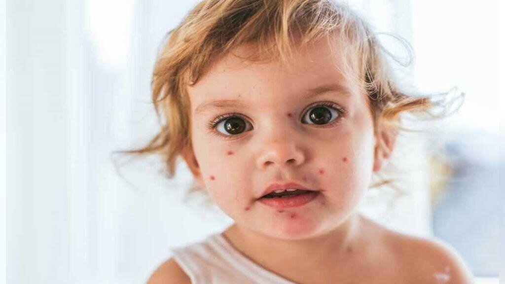 افزایش شیوع سرخک در کشور