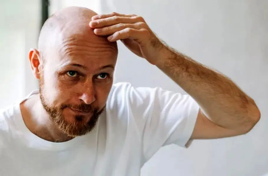 داروی جدید طاسی رشد مو را ۵۳۹٪ افزایش می‌دهد