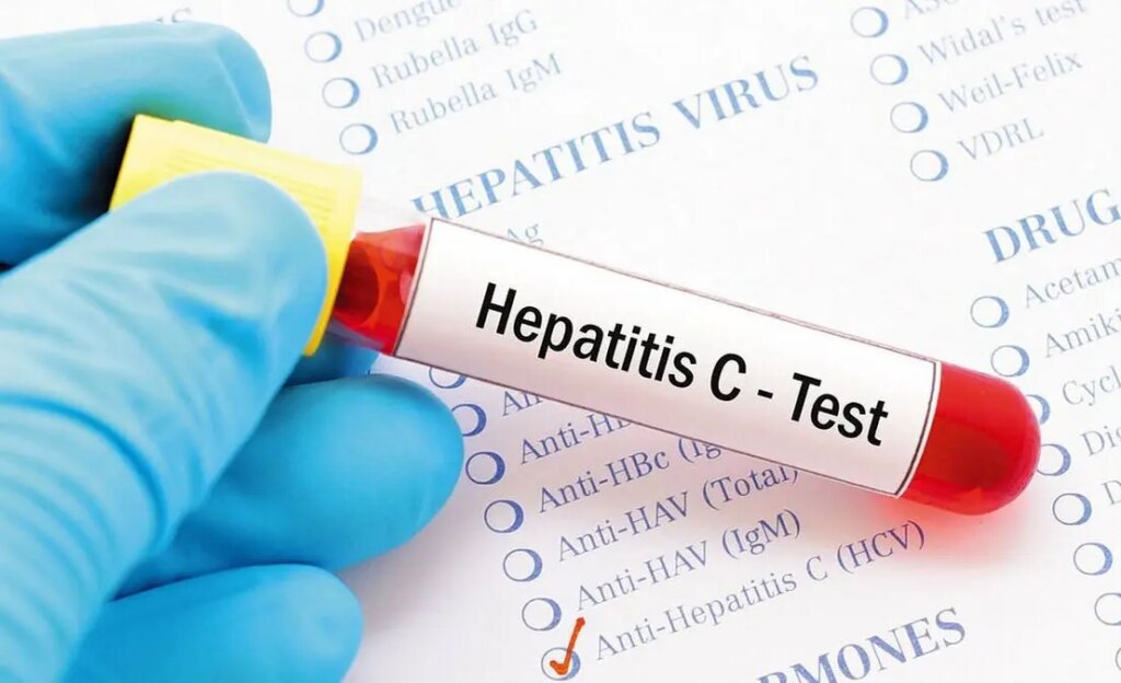 دانشمندان هپاتیت C را در ۱۵ دقیقه تشخیص دادند!