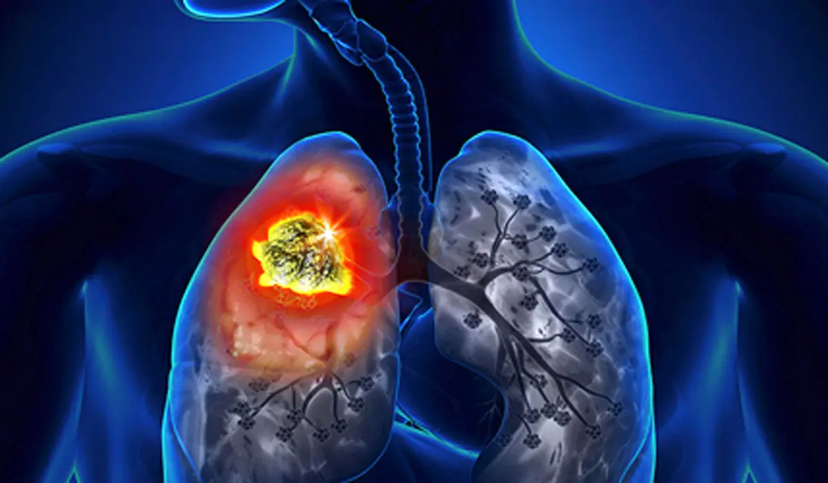 درمان سرطان ریه پیدا شد